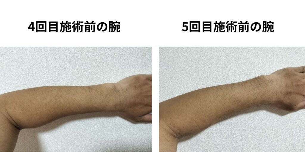 全身脱毛4回目施術前と5回目施術前の腕を比較した40代男性の写真