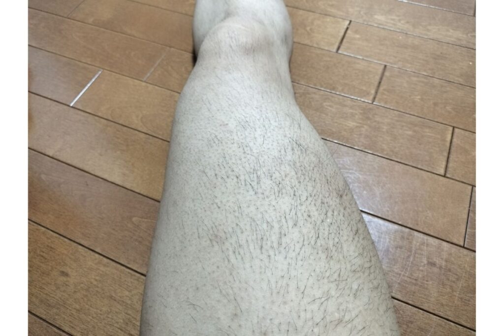 全身脱毛5回目施術前の脚を接写した細い毛が残っている状態