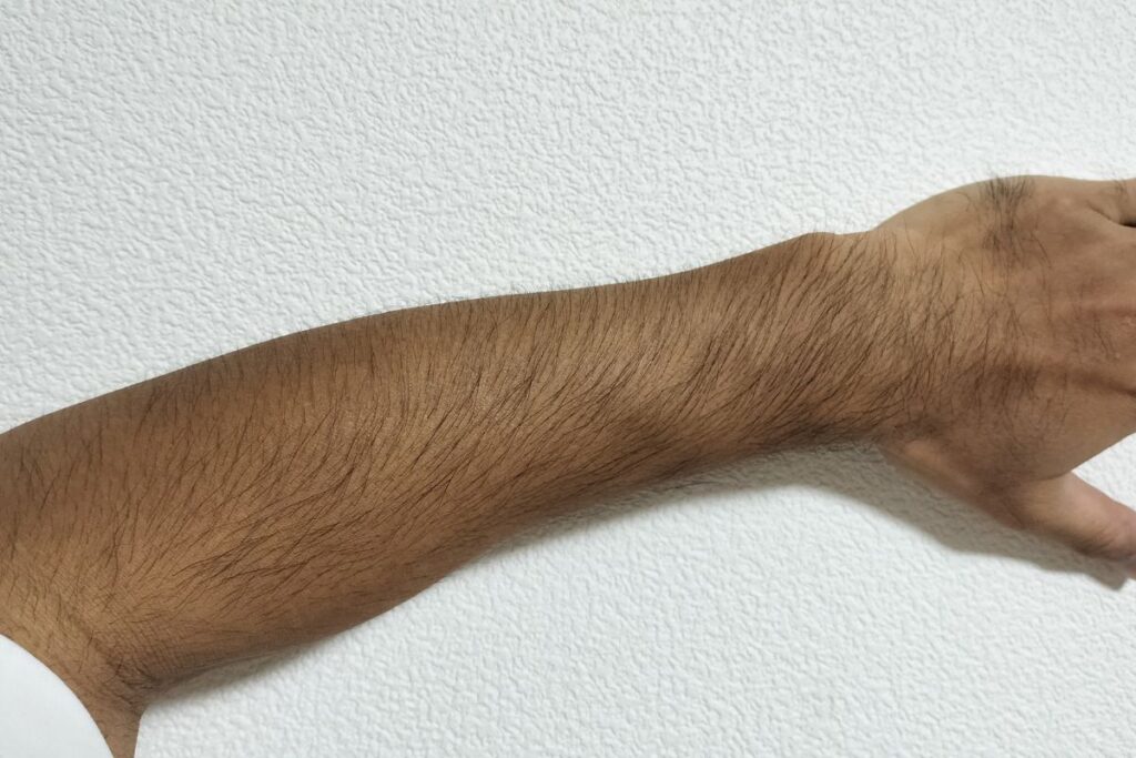 日焼けで医療脱毛の腕照射が難しいと判断された時期に近い40代男性の腕