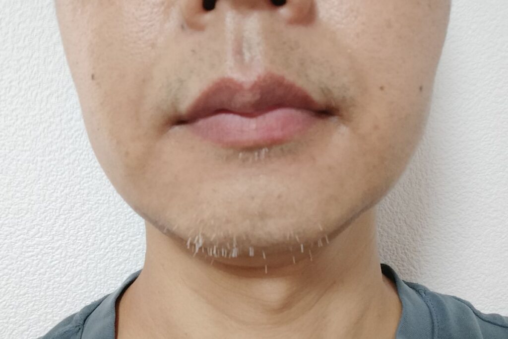 ニードル脱毛前にアゴ周りの白髪ヒゲが目立っていた状態