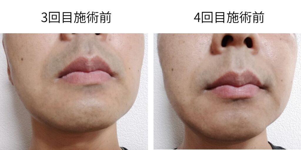 ヒゲ脱毛3回目施術前と4回目施術前の青みを比較した写真