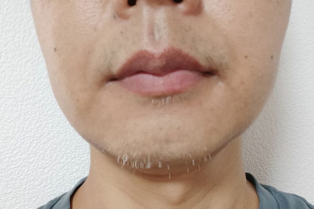ヒゲ脱毛6回目ポロ期後に白髪が目立ったアゴ周り
